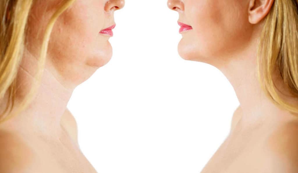 Double Chin treatment Maplehurst before and after results