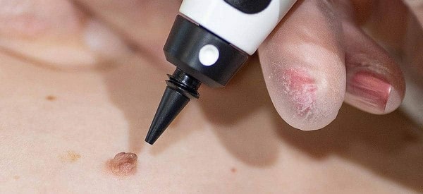 After Skin Tag Removal Maplehurst