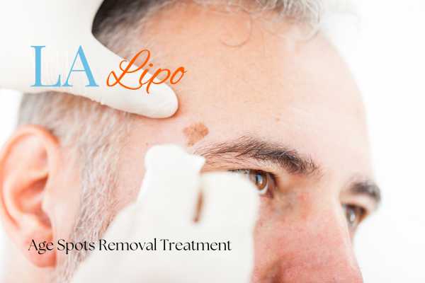What Are the Most Effective Treatments for Age Spots Maplehurst?
