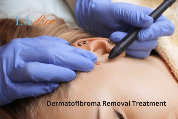 Dermatofibroma Removal Treatment Maplehurst