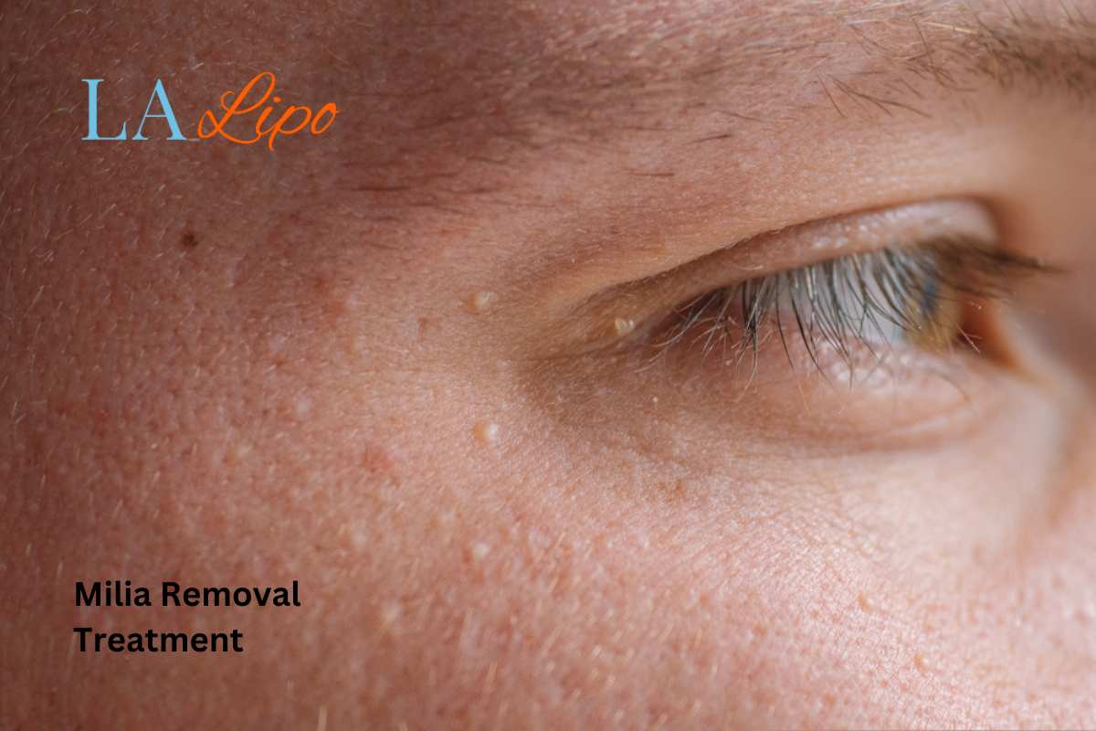 Cryopen Milia Removal: Is It the Easiest and Safest Option Maplehurst?