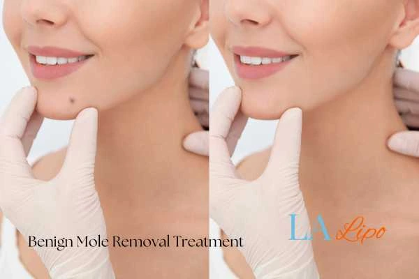 Before-and-after results following benign mole-removal treatment Maplehurst