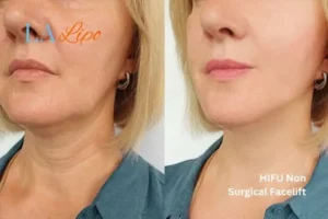 hi-fu for wrinkles Maplehurst before and after results