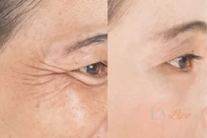 Before and after results of woman - HI-fu wrinkles reduction treatment Maplehurst