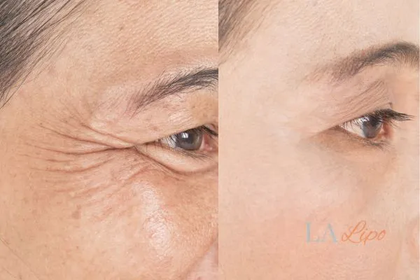 Before and after results of woman - HI-fu wrinkles reduction treatment Maplehurst