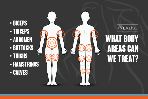 Graphic to show areas you can have LA-EMS Body Sculpting Maplehurst treatment.