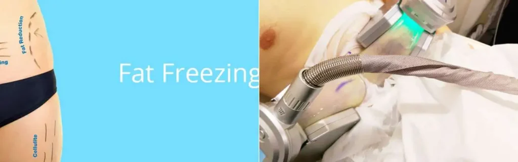 Fat freezing Maplehurst on multiple areas of the body
