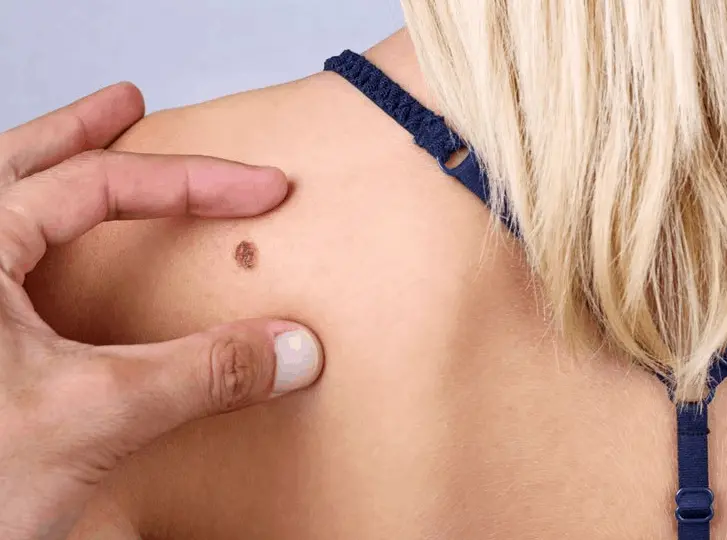 woman having mole removal Maplehurst consultation before treatment.