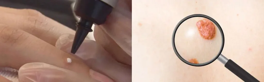 Cryopen for mole removal Maplehurst - speak to our team today!