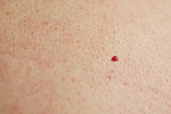 close up of a cherry angioma Maplehurst