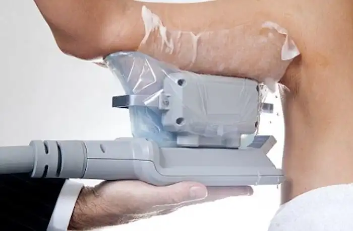 Picture of fat freezing Maplehurst on the upper arms.