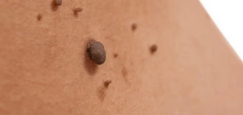 image of a skin tag Maplehurst