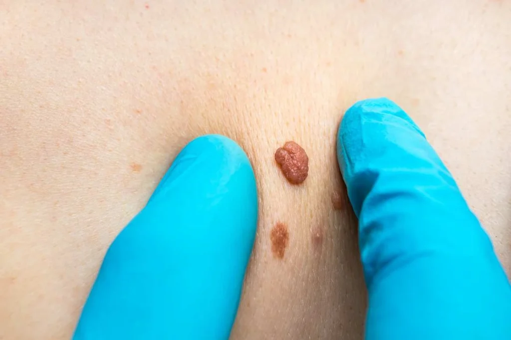 Consultant examining a skin tag Maplehurst