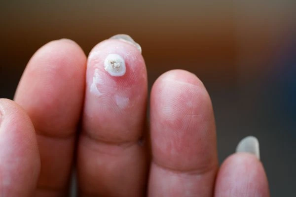 wart on person finger - cryotherapy to treat from LA LIPO Maplehurst
