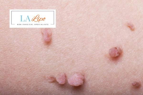 Does cryopen skin tag removal Maplehurst hurt? Find out now call our team today!
