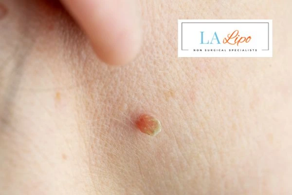 Book skin tag removal Maplehurst today speak to our team now!