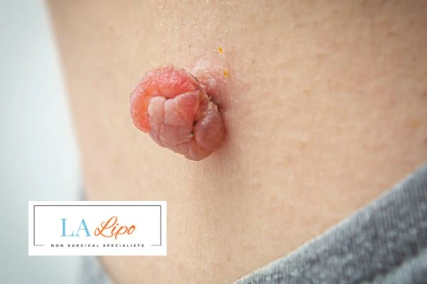 Interested in skin tag removal Maplehurst? Concerned about the pain? Find out more today!