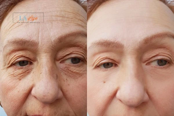 The powerful benefits of Morpheus8 Treatment Maplehurst - Call Our team today!