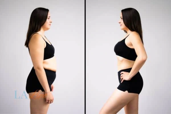 Picture of womans before and after using LA-EMS body sculpting to improve her core strength Maplehurst