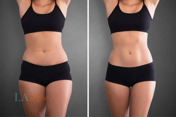 before and after results of non-surgical treatment to help a woman's body image and mental health Maplehurst