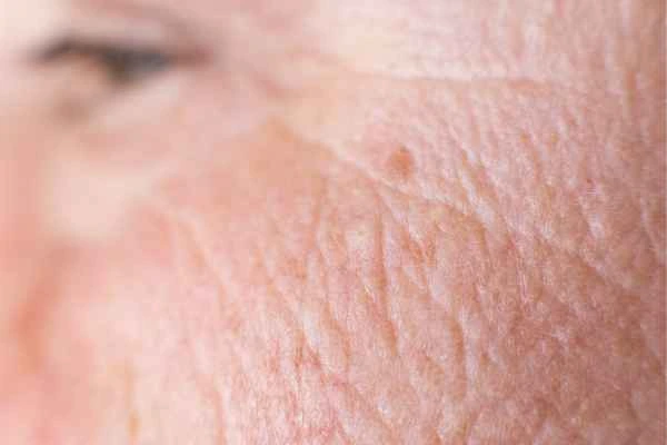 close up picture of a woman's face showing an age spot Maplehurst