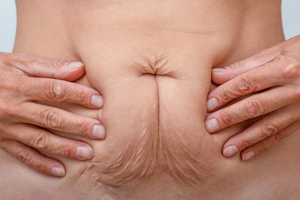 Should I Combine Diastasis Recti Treatment with Body Contouring for Better Results Maplehurst?