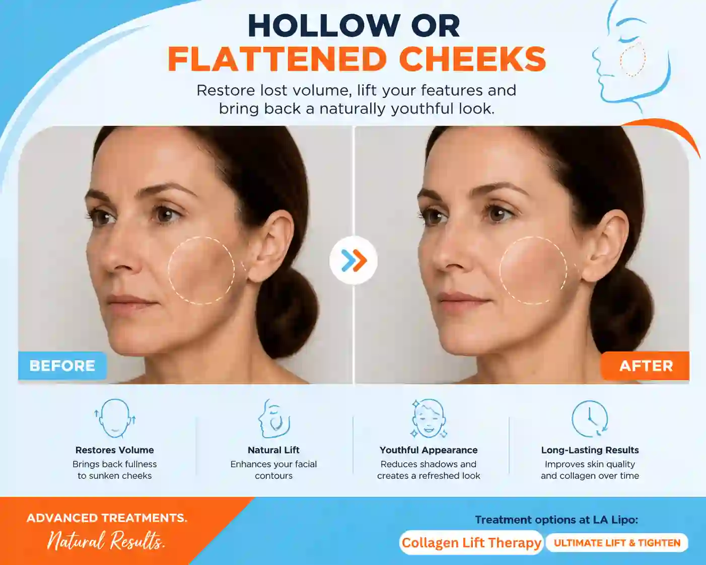 Sign #4: Hollow or Flattened Cheeks Maplehurst