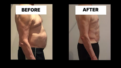 What Symptoms Can Diastasis Recti Cause in Men? Weak Core, Back Pain and Poor Posture Maplehurst